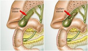 Gallenblase mit und ohne Gallenstein